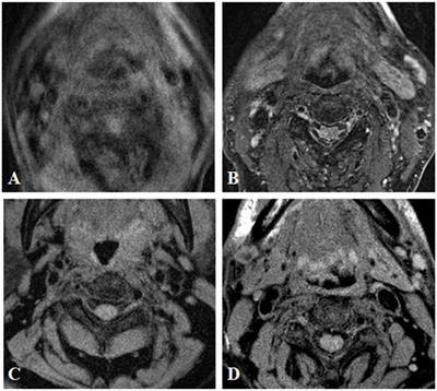 Morphological feature and mapping inflammation in classified carotid plaques in symptomatic and asymptomatic patients: A hybrid 18F-FDG PET/MR study